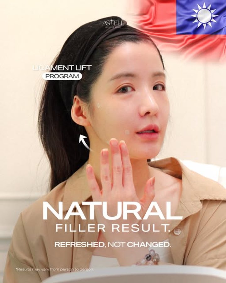 Ligament Lift Program — a natural filler result