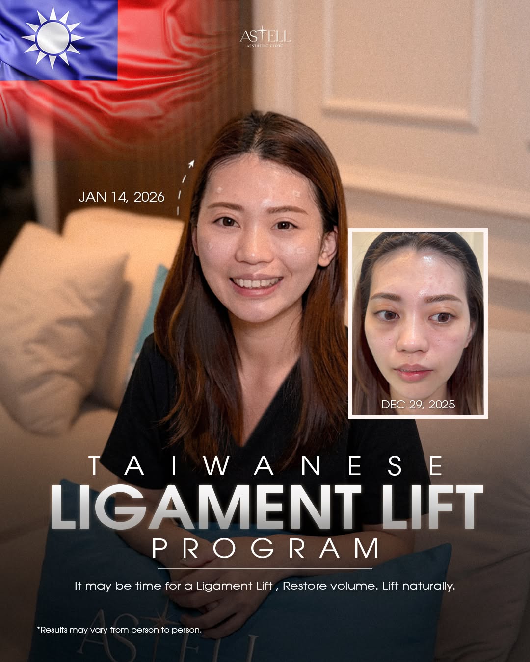 Patient from Taiwan — ligament lift result