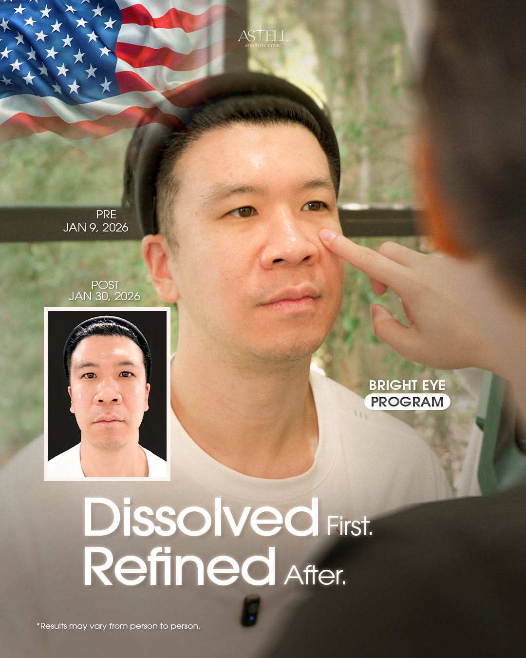Patient from the United States — under-eye result