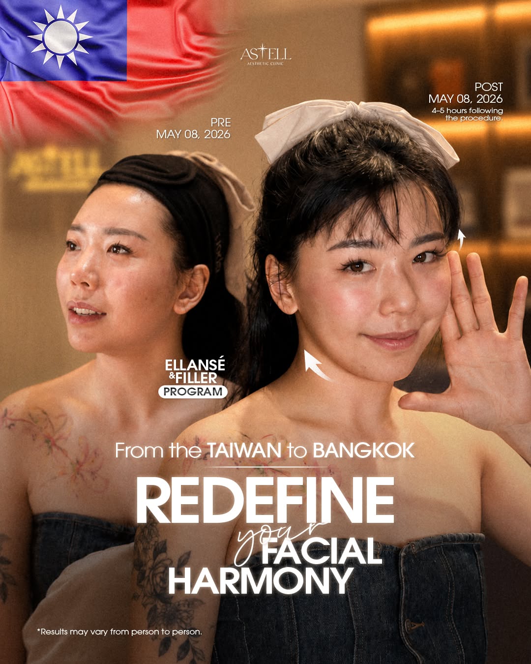 Patient from Taiwan — facial harmony, before and after