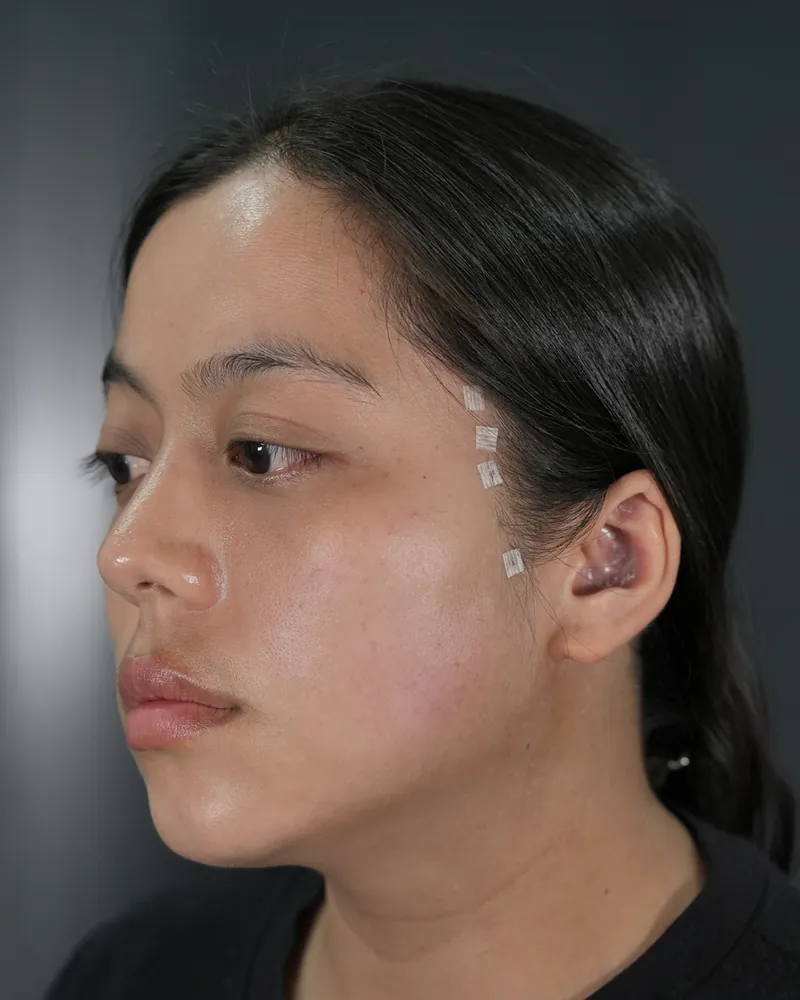 Cheeks Lift & Jawline Lift &mdash; after, an actual patient of The Astell Clinic