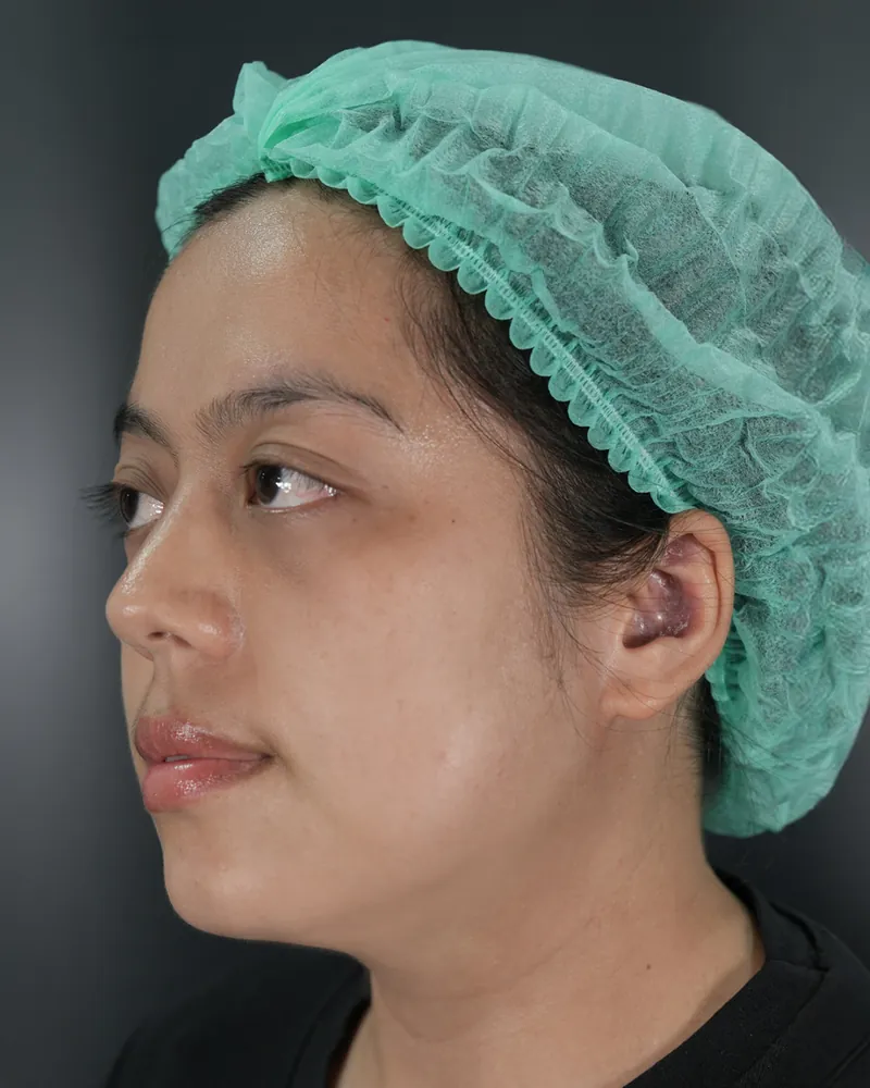 Cheeks Lift & Jawline Lift &mdash; before
