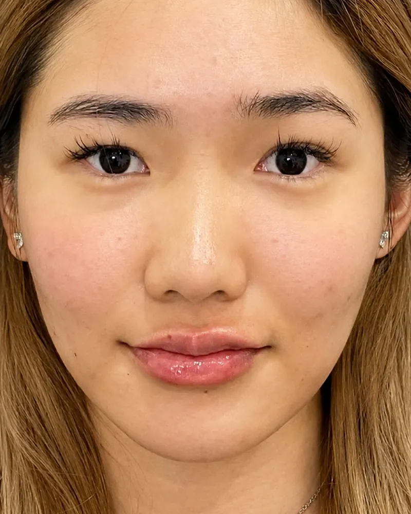 Chin Filler &mdash; after, an actual patient of The Astell Clinic