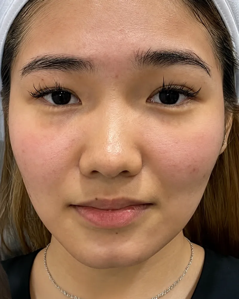 Chin Filler &mdash; before