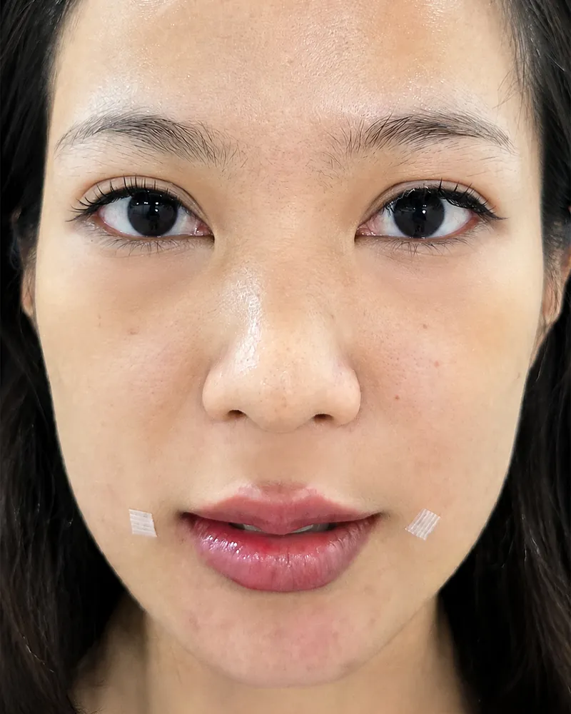 Chin Filler + Lip Filler &mdash; after, an actual patient of The Astell Clinic
