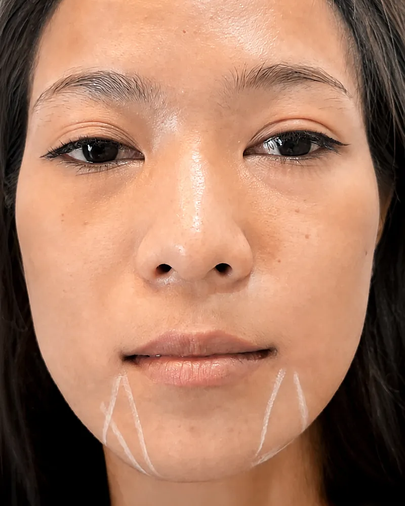 Chin Filler + Lip Filler &mdash; before