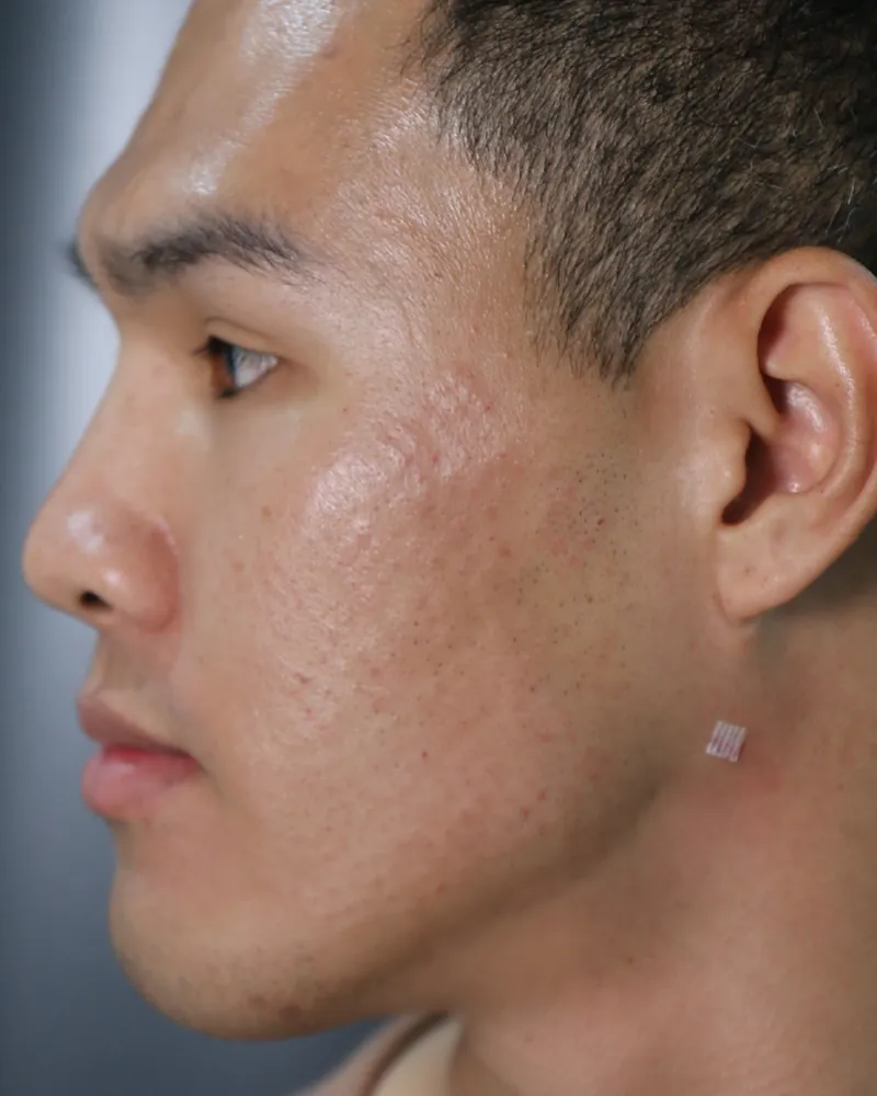 Double Chin Lift &mdash; after, an actual patient of The Astell Clinic