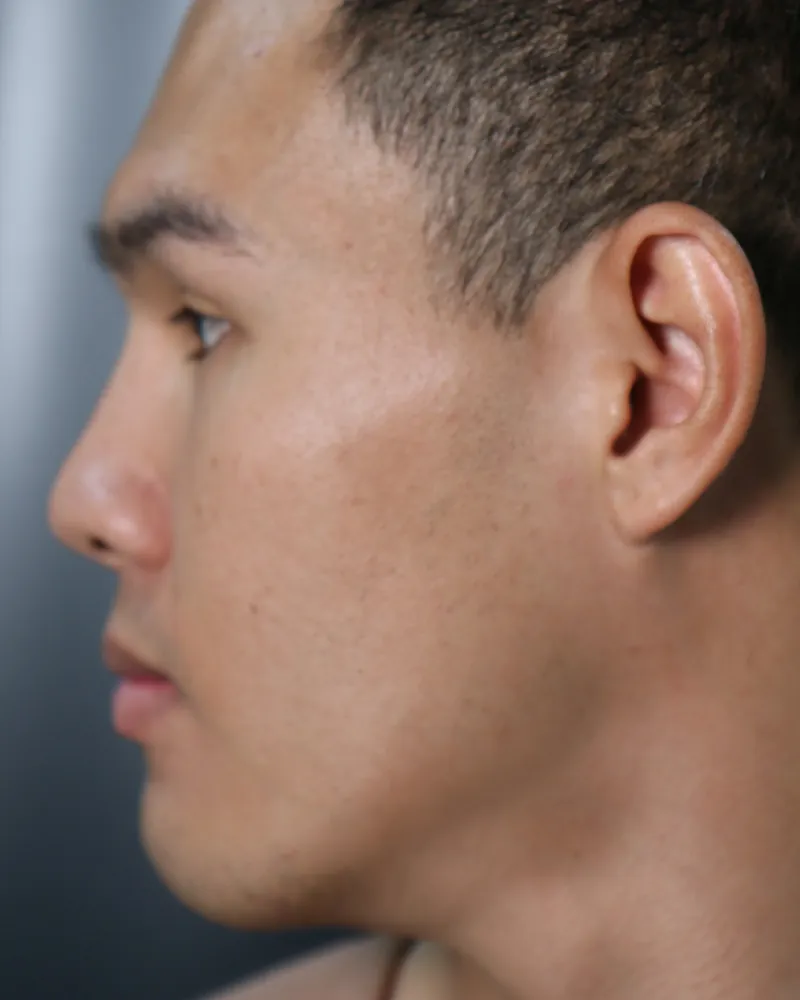 Double Chin Lift &mdash; before