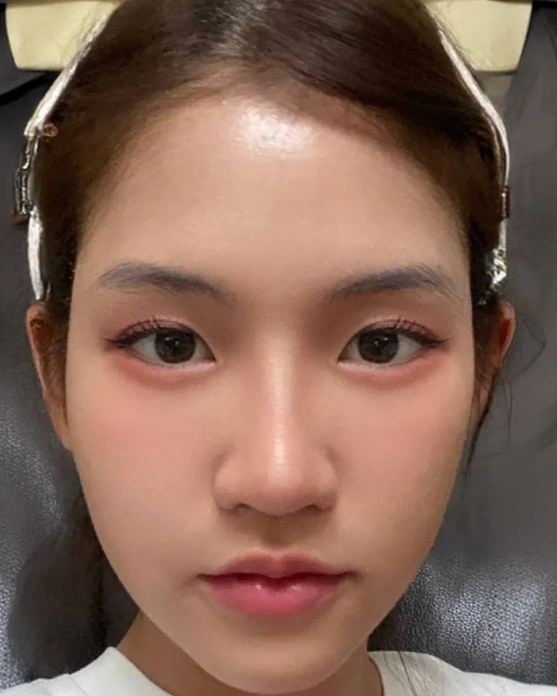 Douyin Style &mdash; after, an actual patient of The Astell Clinic