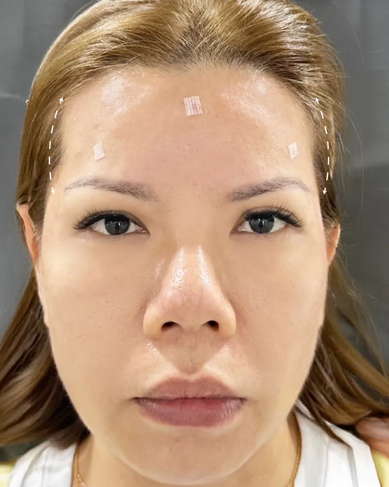 Forehead Filler &mdash; after, an actual patient of The Astell Clinic
