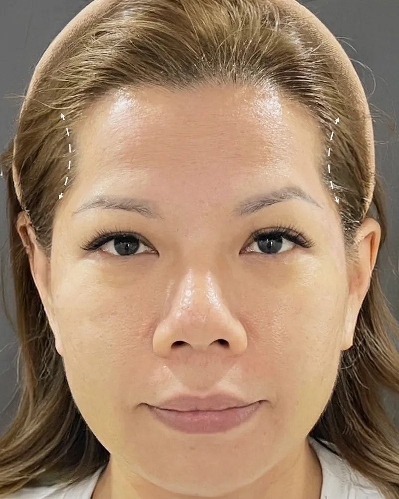 Forehead Filler &mdash; before