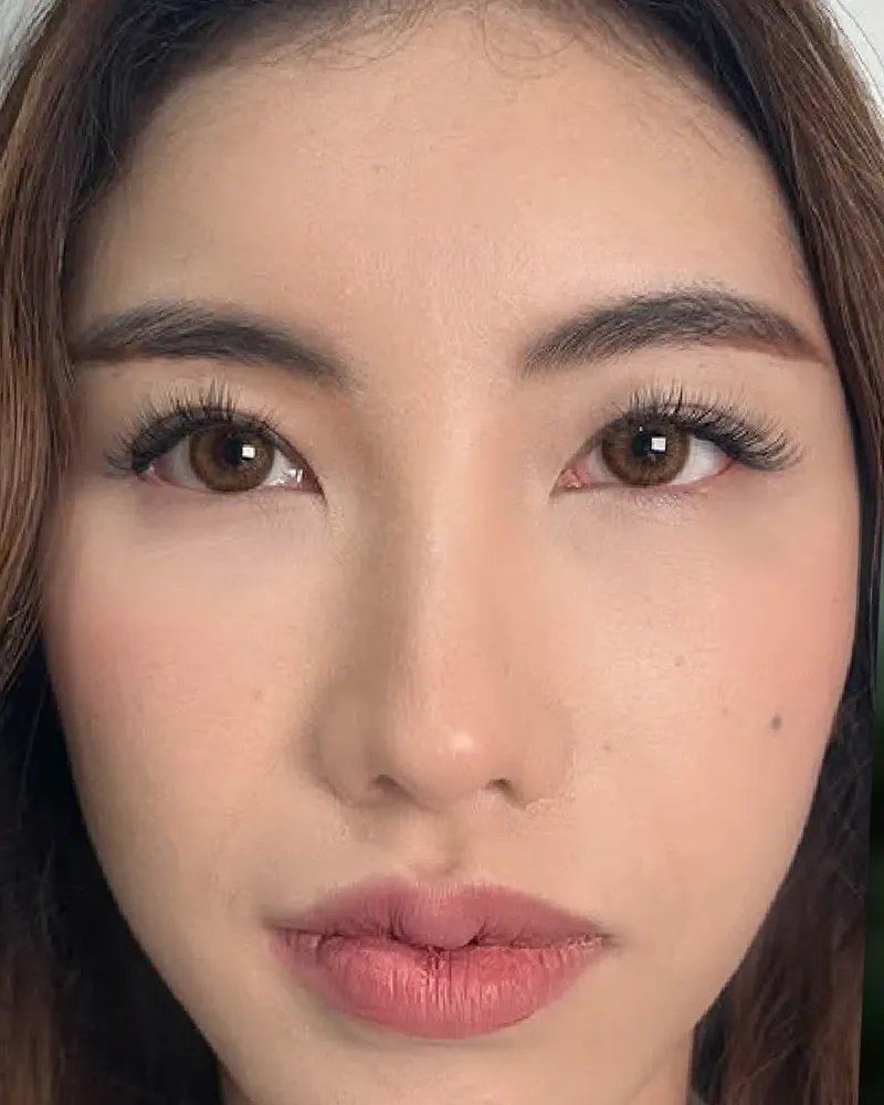 Forehead Filler &mdash; after, an actual patient of The Astell Clinic