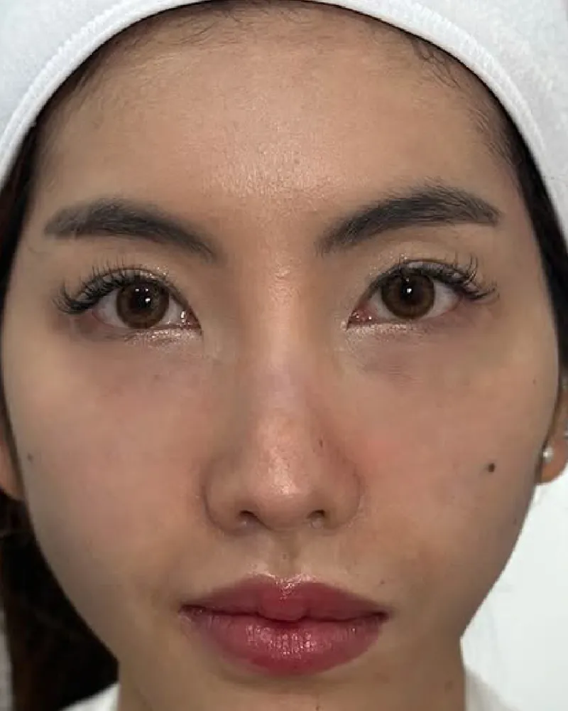 Forehead Filler &mdash; before