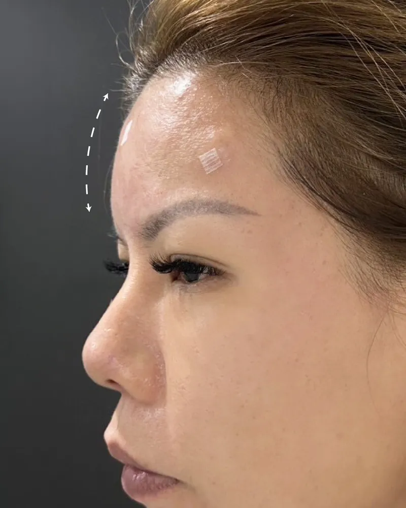 Forehead Filler &mdash; after, an actual patient of The Astell Clinic