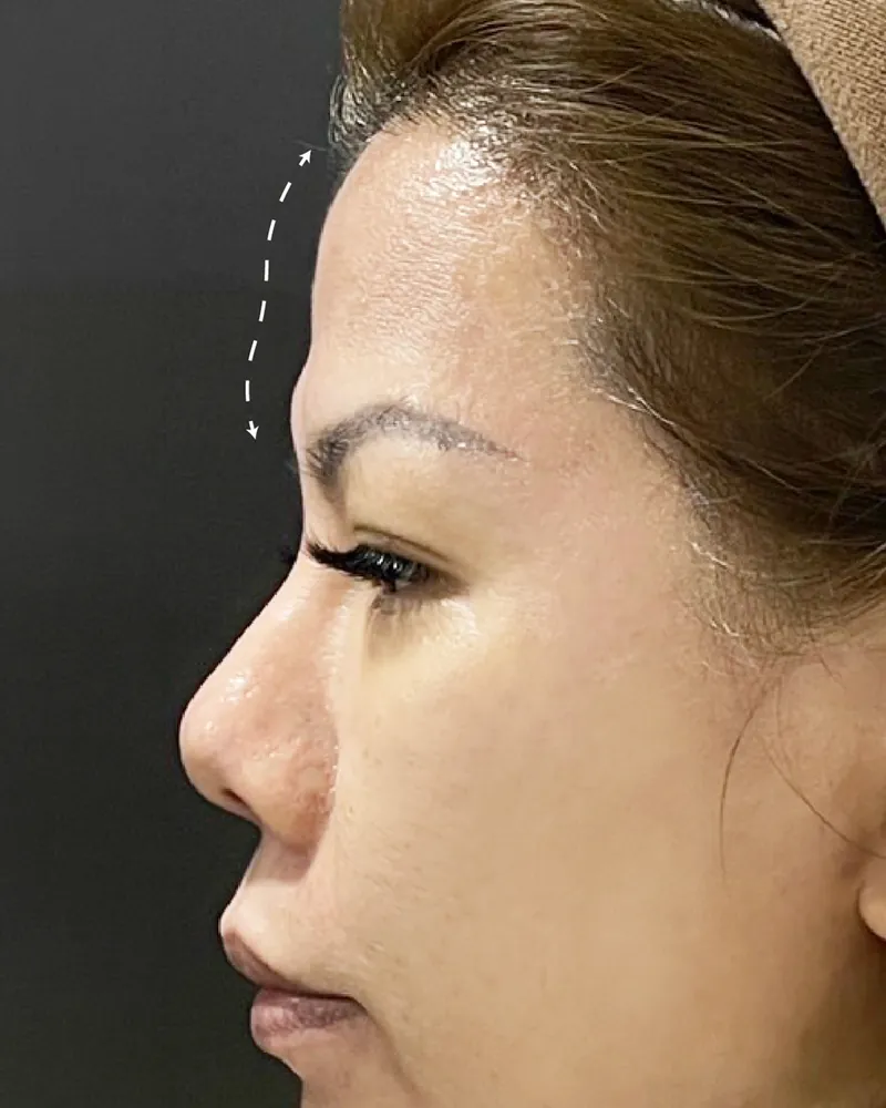 Forehead Filler &mdash; before