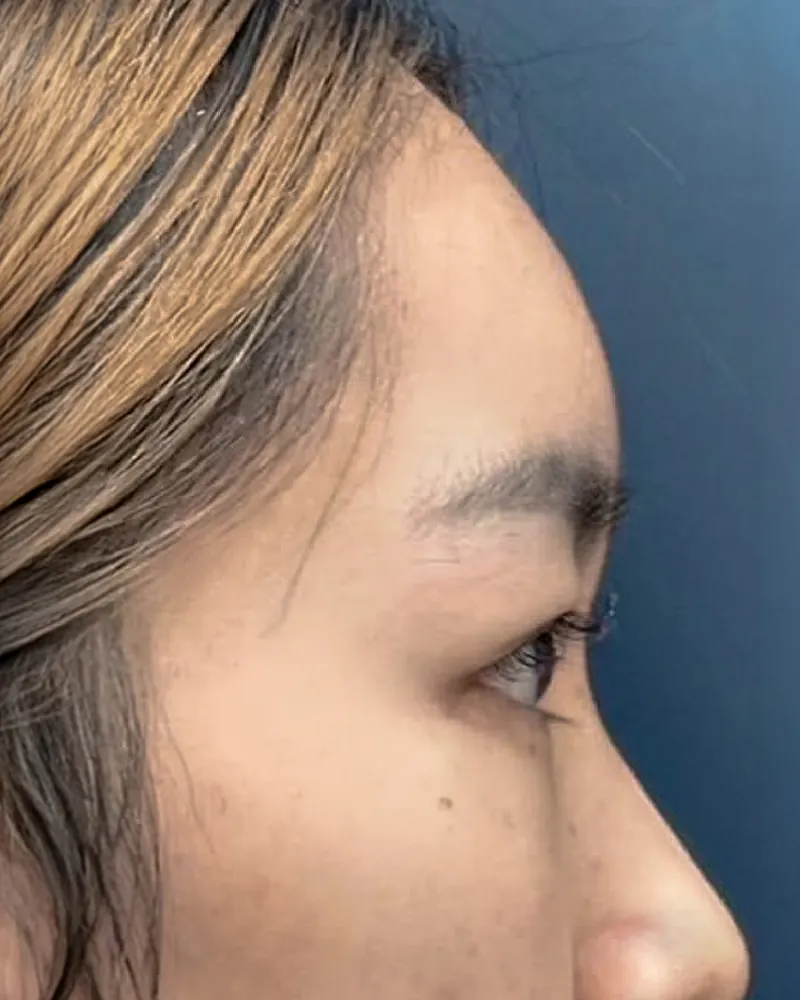 Forehead Filler &mdash; after, an actual patient of The Astell Clinic