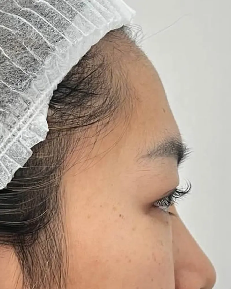 Forehead Filler &mdash; before
