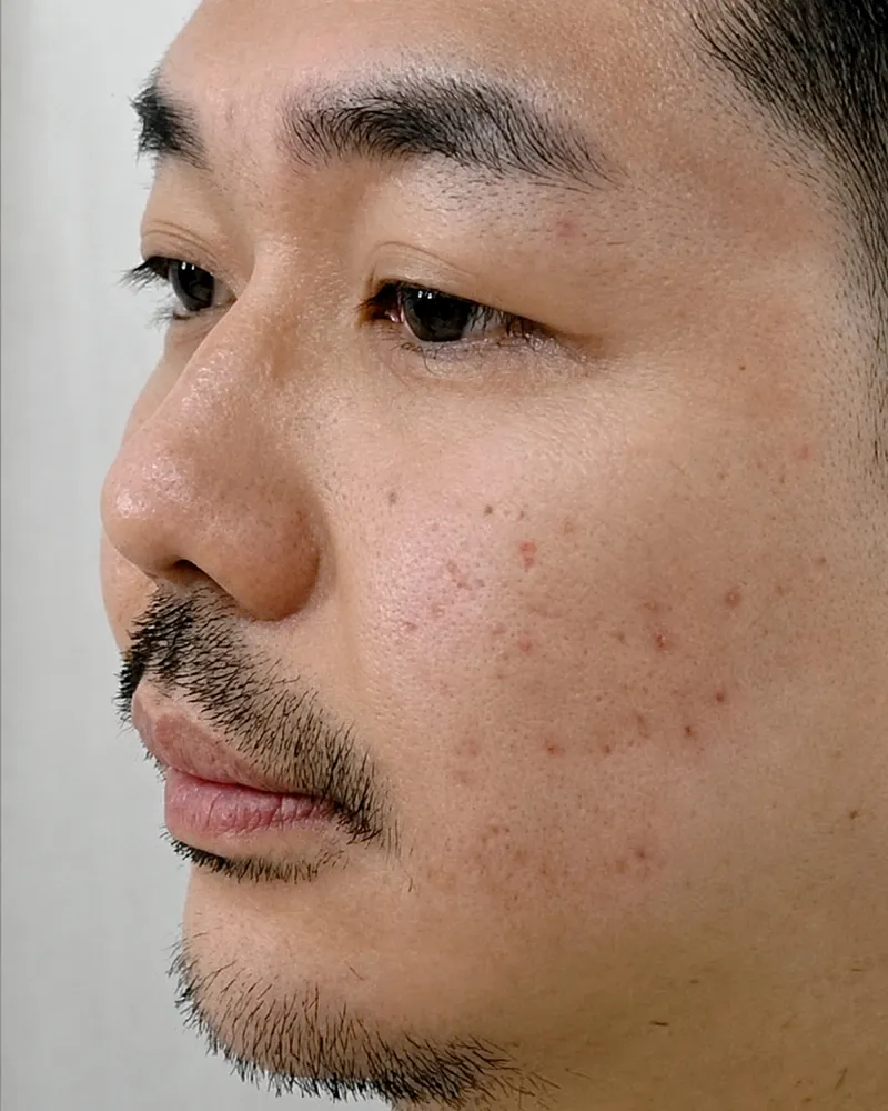 Jawline Filler &mdash; before