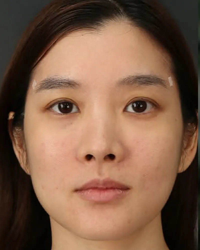 Laugh Line Filler &mdash; after, an actual patient of The Astell Clinic
