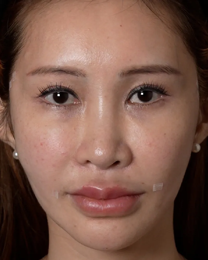 Laugh Line Filler & Thread Lift &mdash; after, an actual patient of The Astell Clinic