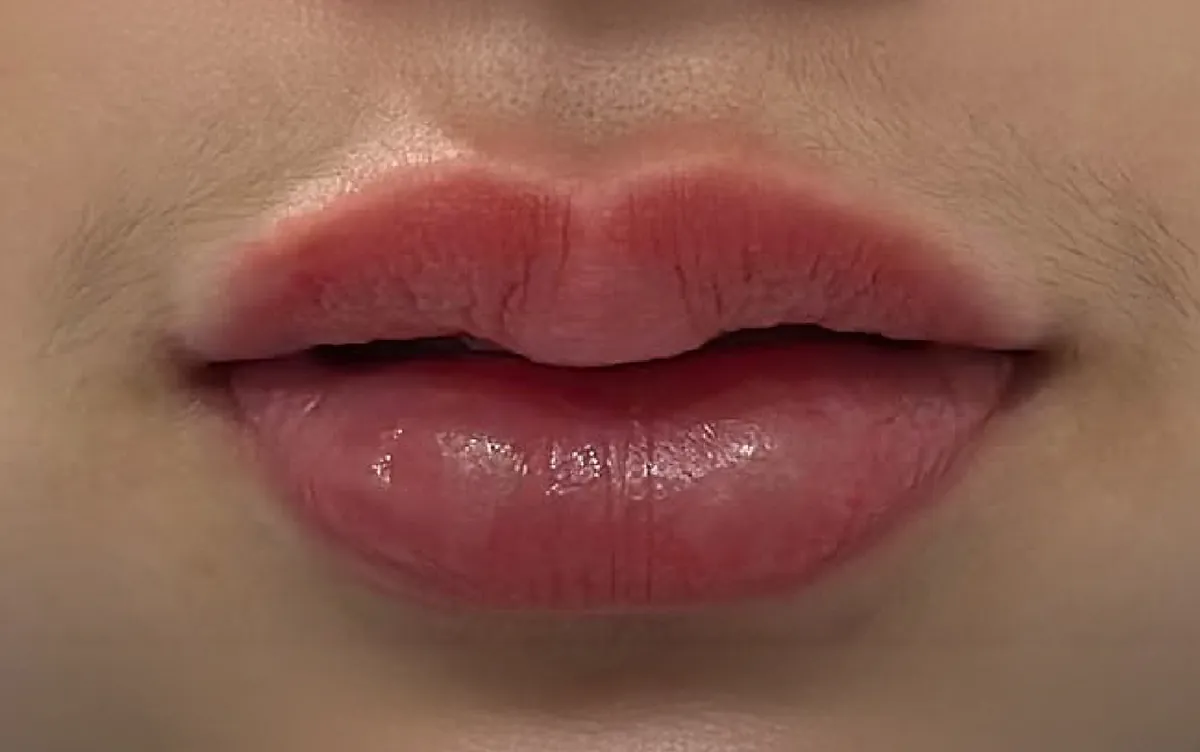 Lip Filler &mdash; after, an actual patient of The Astell Clinic