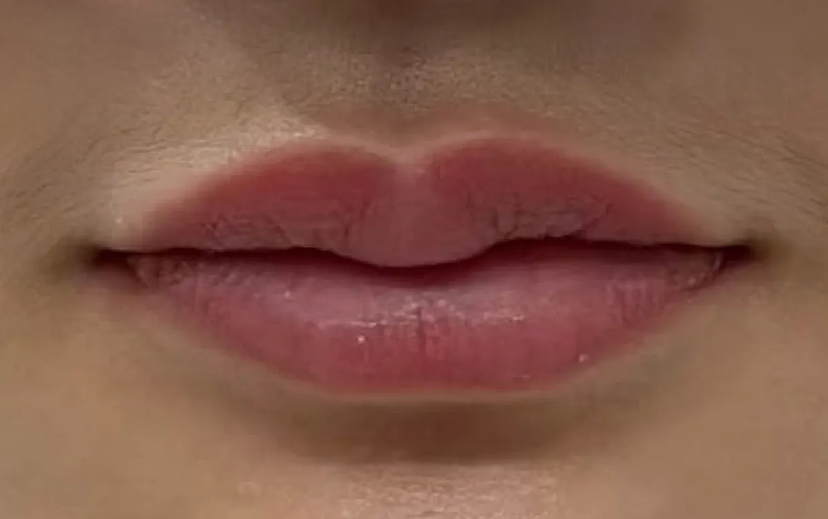 Lip Filler &mdash; before