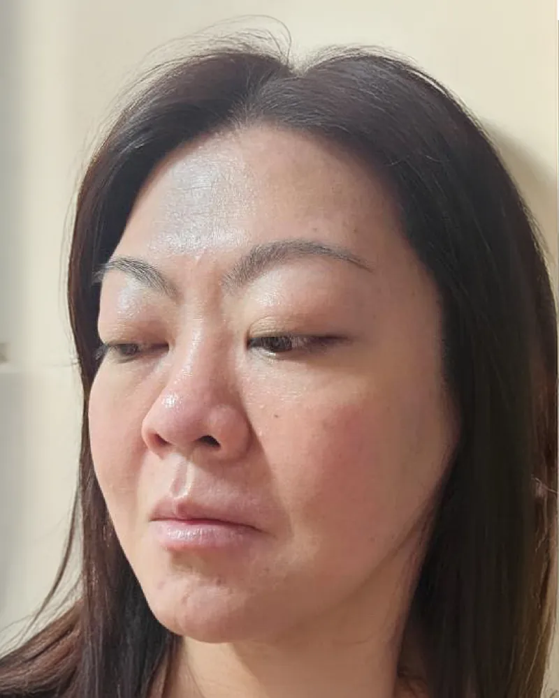 Thread Lift &mdash; after, an actual patient of The Astell Clinic