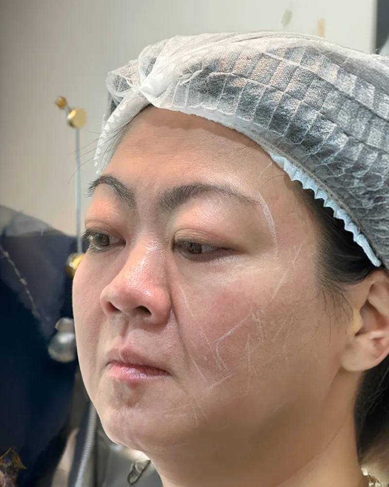 Thread Lift &mdash; before