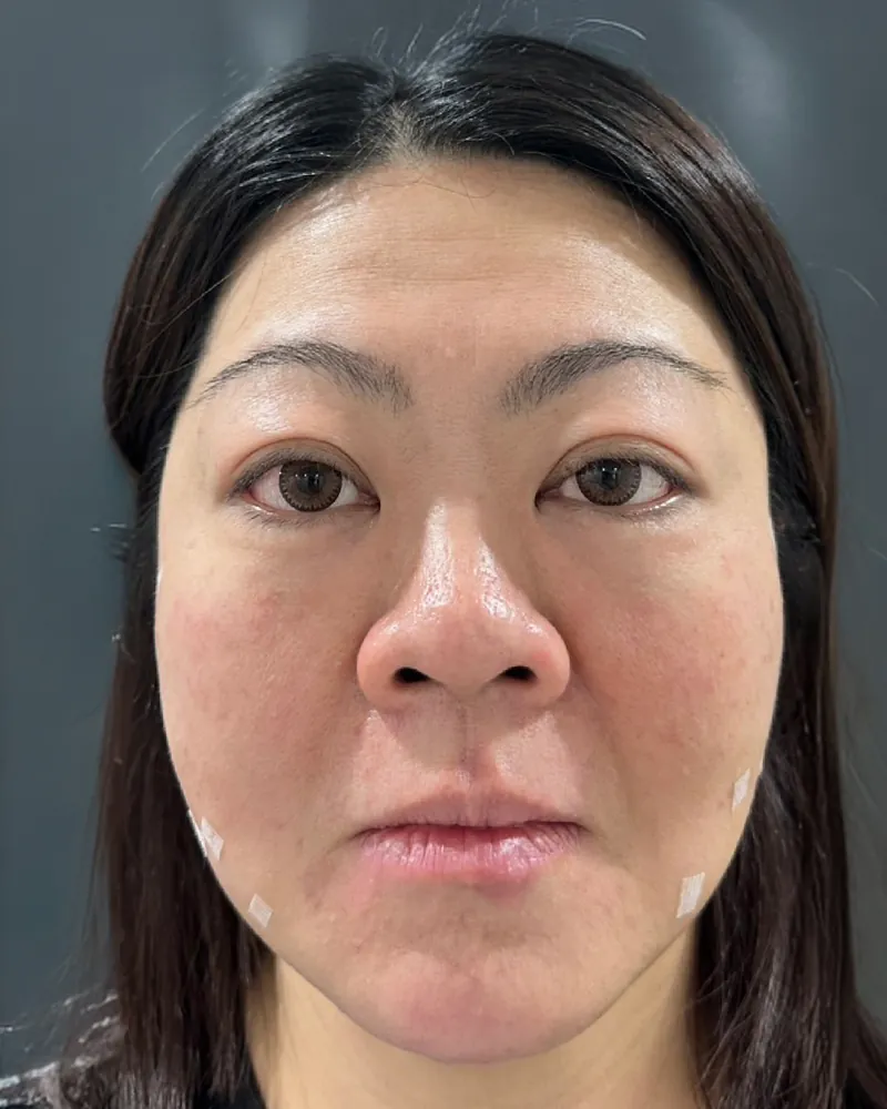 Thread Lift &mdash; after, an actual patient of The Astell Clinic