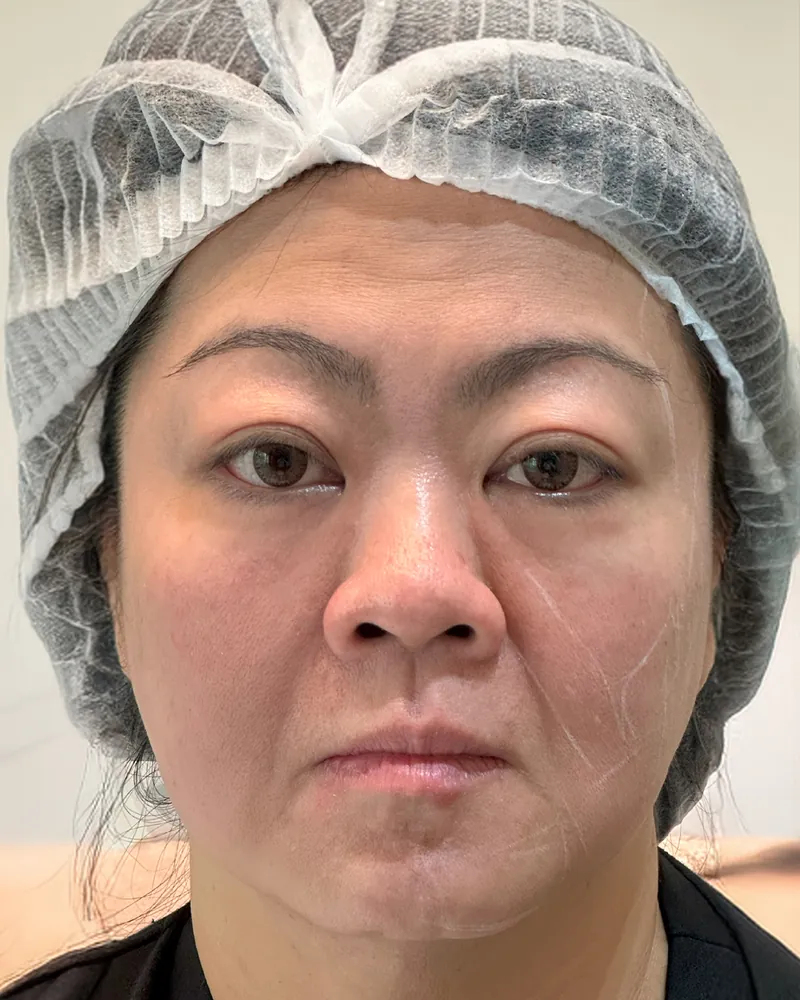 Thread Lift &mdash; before