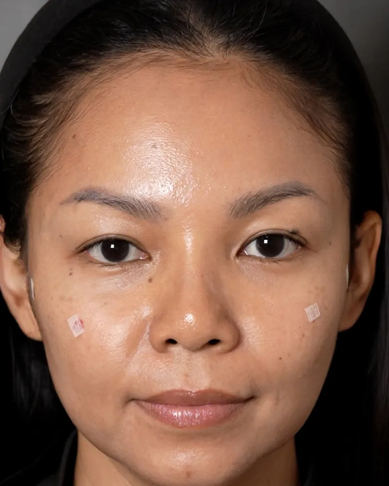 Under-Eye Filler &mdash; after, an actual patient of The Astell Clinic