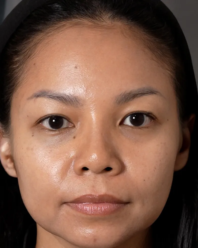 Under-Eye Filler &mdash; before