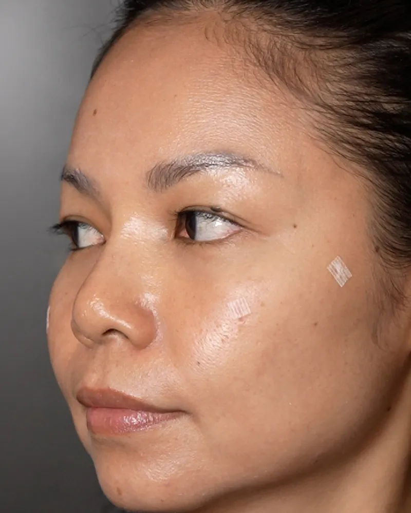 Under-Eye Filler &mdash; after, an actual patient of The Astell Clinic