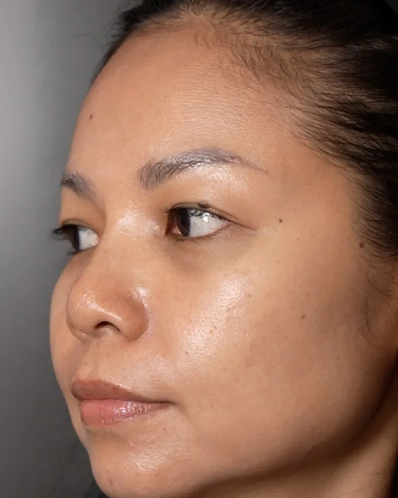Under-Eye Filler &mdash; before