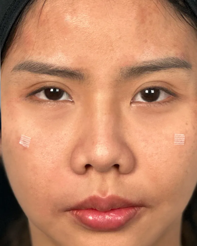 Under-Eye Filler &mdash; after, an actual patient of The Astell Clinic