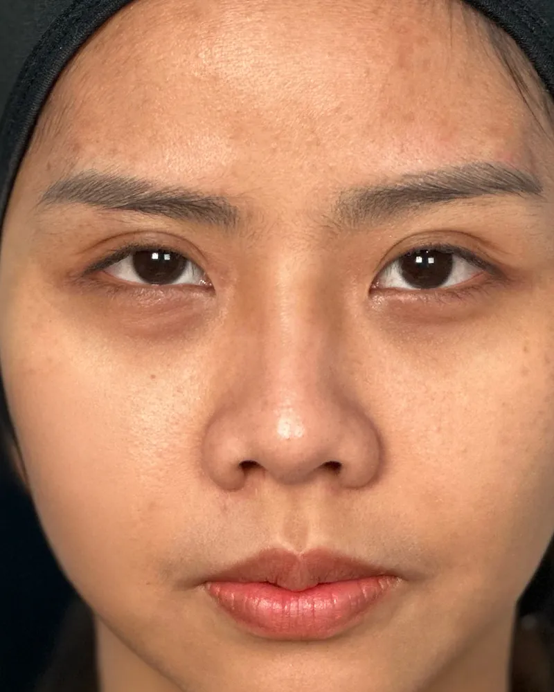 Under-Eye Filler &mdash; before
