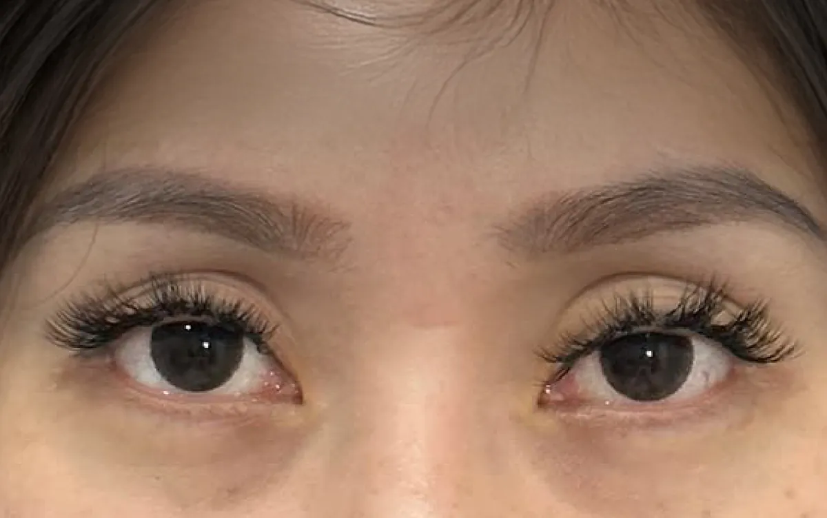 Under-Eye Filler &mdash; after, an actual patient of The Astell Clinic