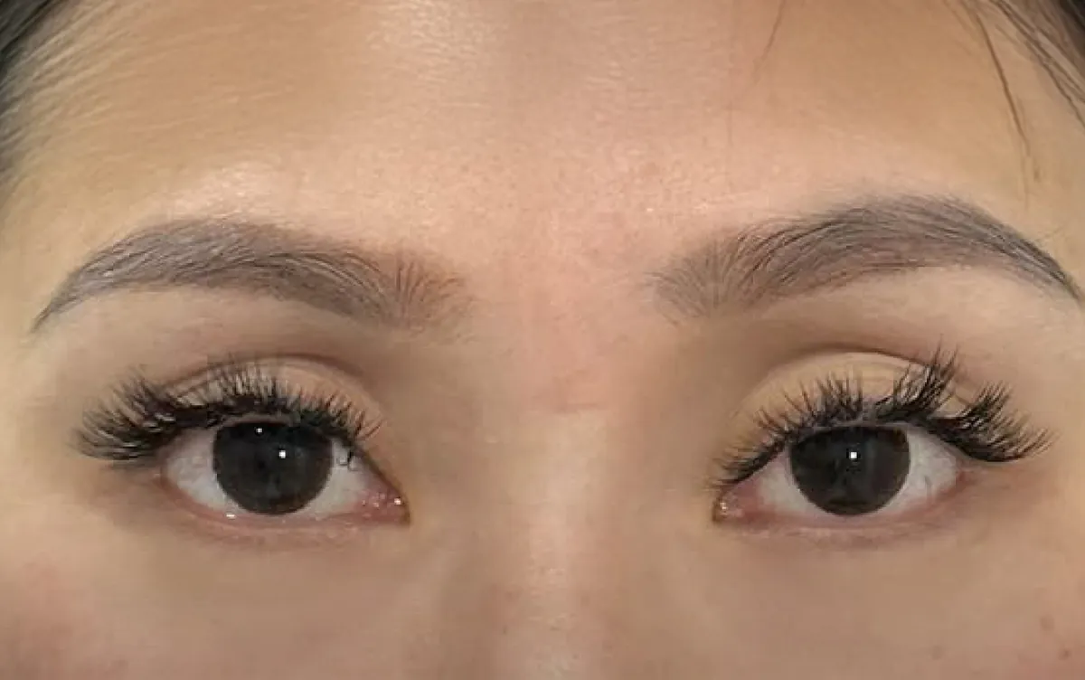 Under-Eye Filler &mdash; before
