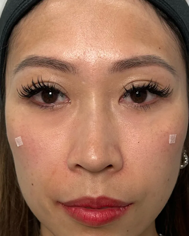 Under-Eye Filler &mdash; after, an actual patient of The Astell Clinic