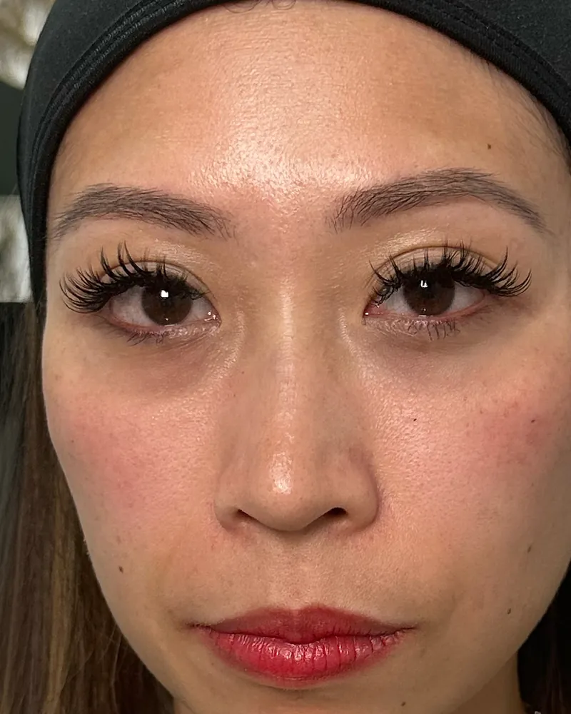 Under-Eye Filler &mdash; before