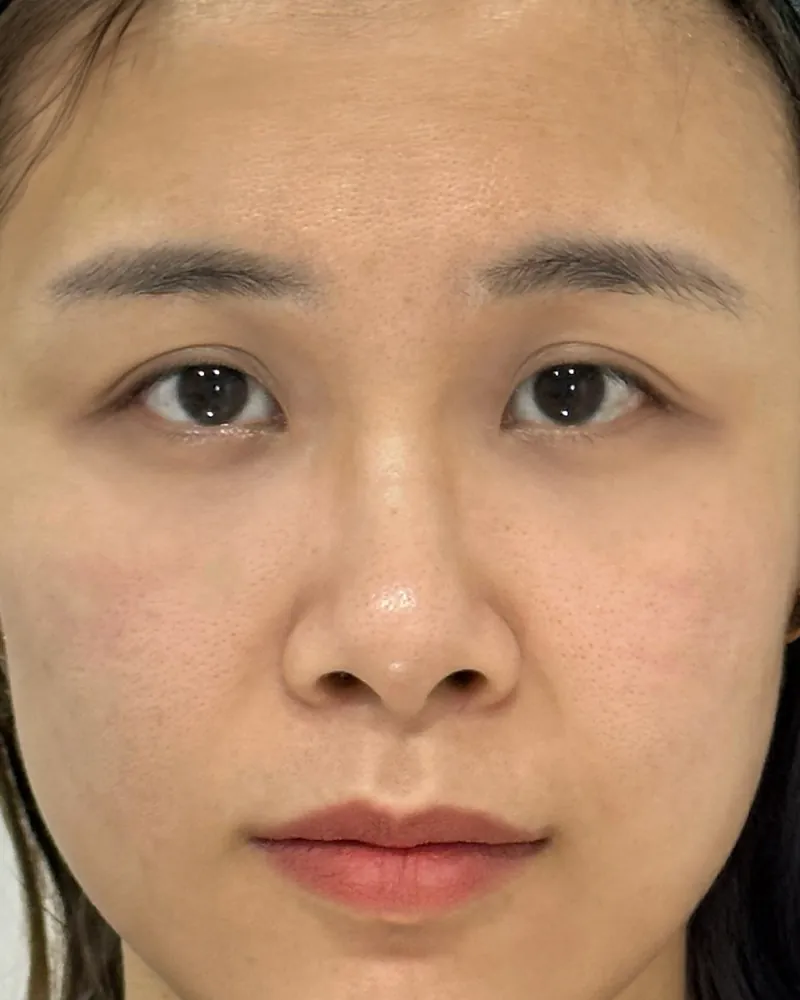Under-Eye Filler &mdash; after, an actual patient of The Astell Clinic