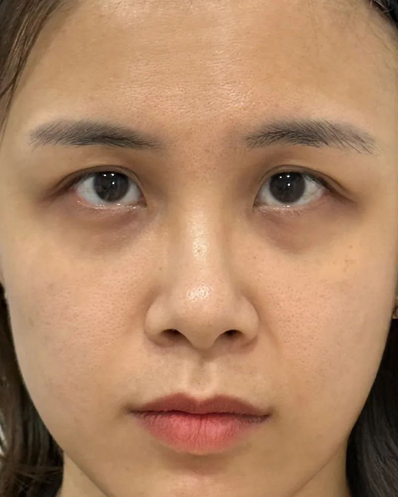 Under-Eye Filler &mdash; before